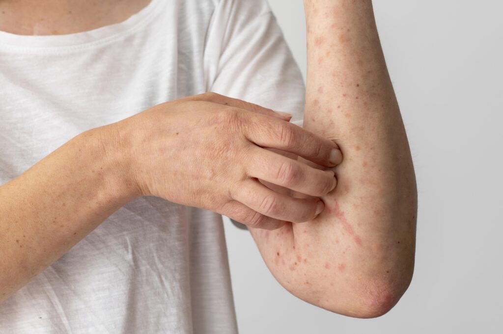 Measles cases in india