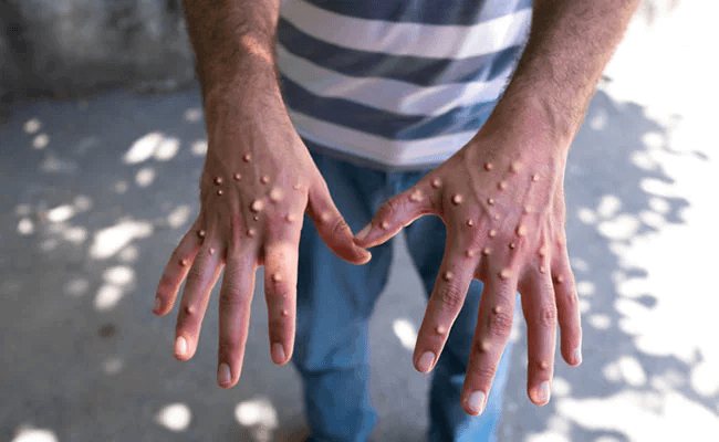 Monkey pox a global pandemic: मंकी पॉक्स को who ने ग्लोबल महामारी घोषित किया, जानें मंकी पॉक्स के बारे में 2 Monkey pox a global pandemic