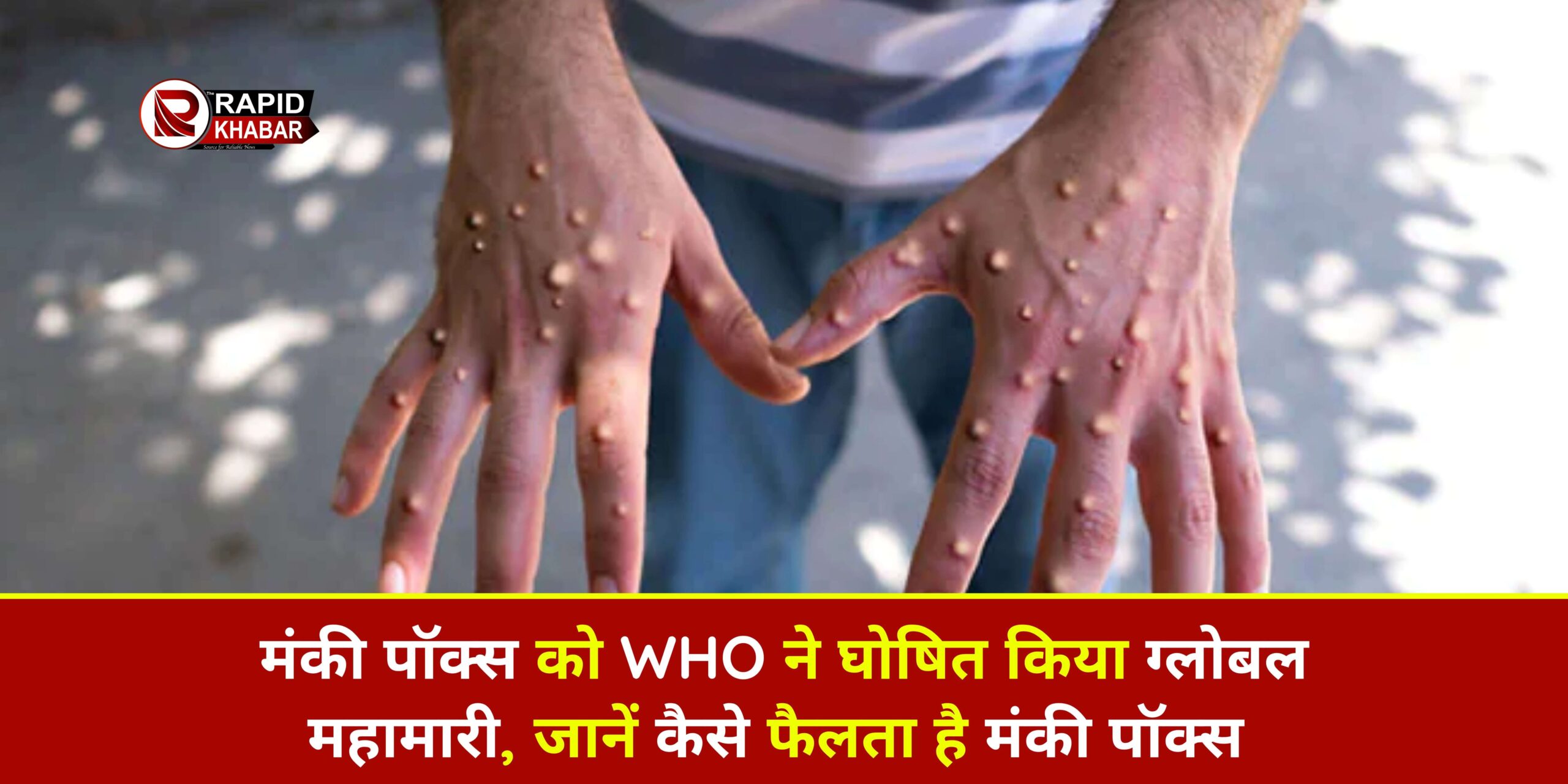 Monkey Pox a Global Pandemic
