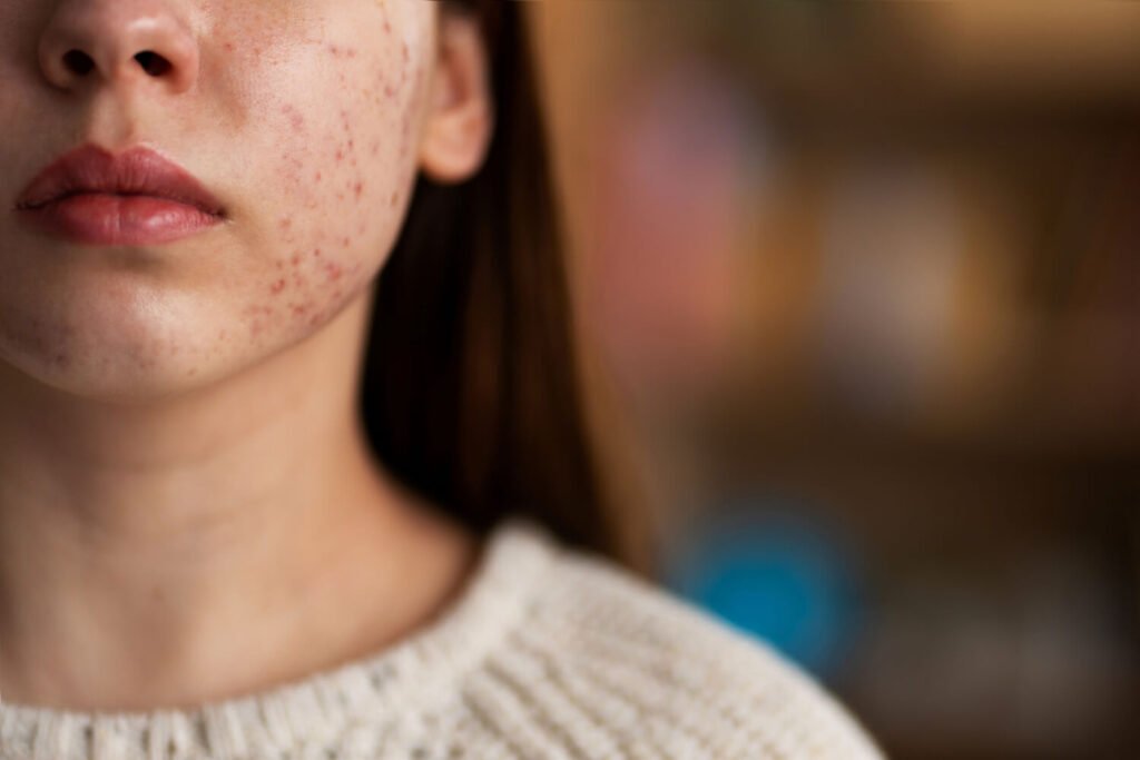 Monkey pox a global pandemic: मंकी पॉक्स को who ने ग्लोबल महामारी घोषित किया, जानें मंकी पॉक्स के बारे में 1 Monkey pox a global pandemic