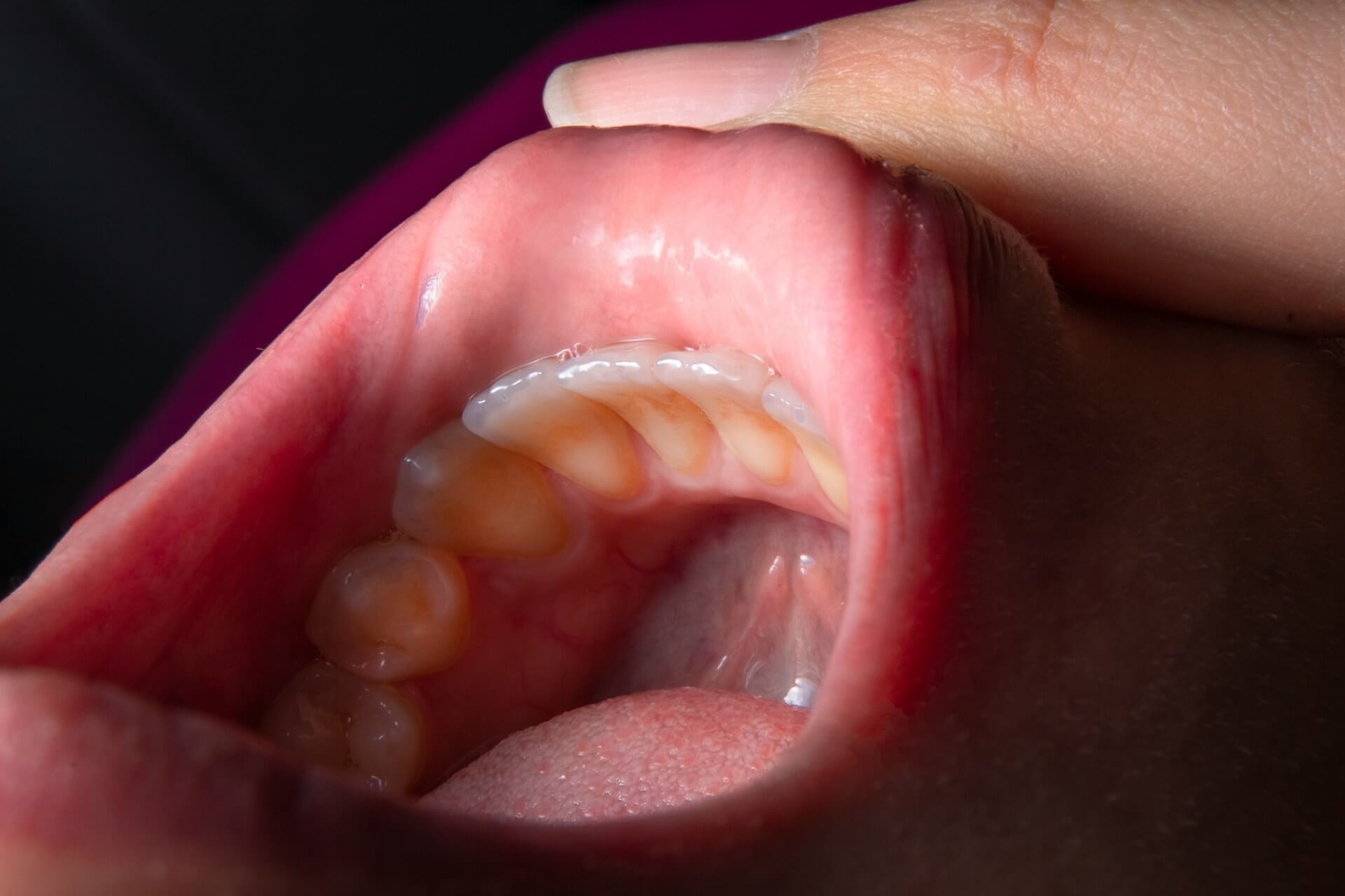 Best home remedies for mouth sores