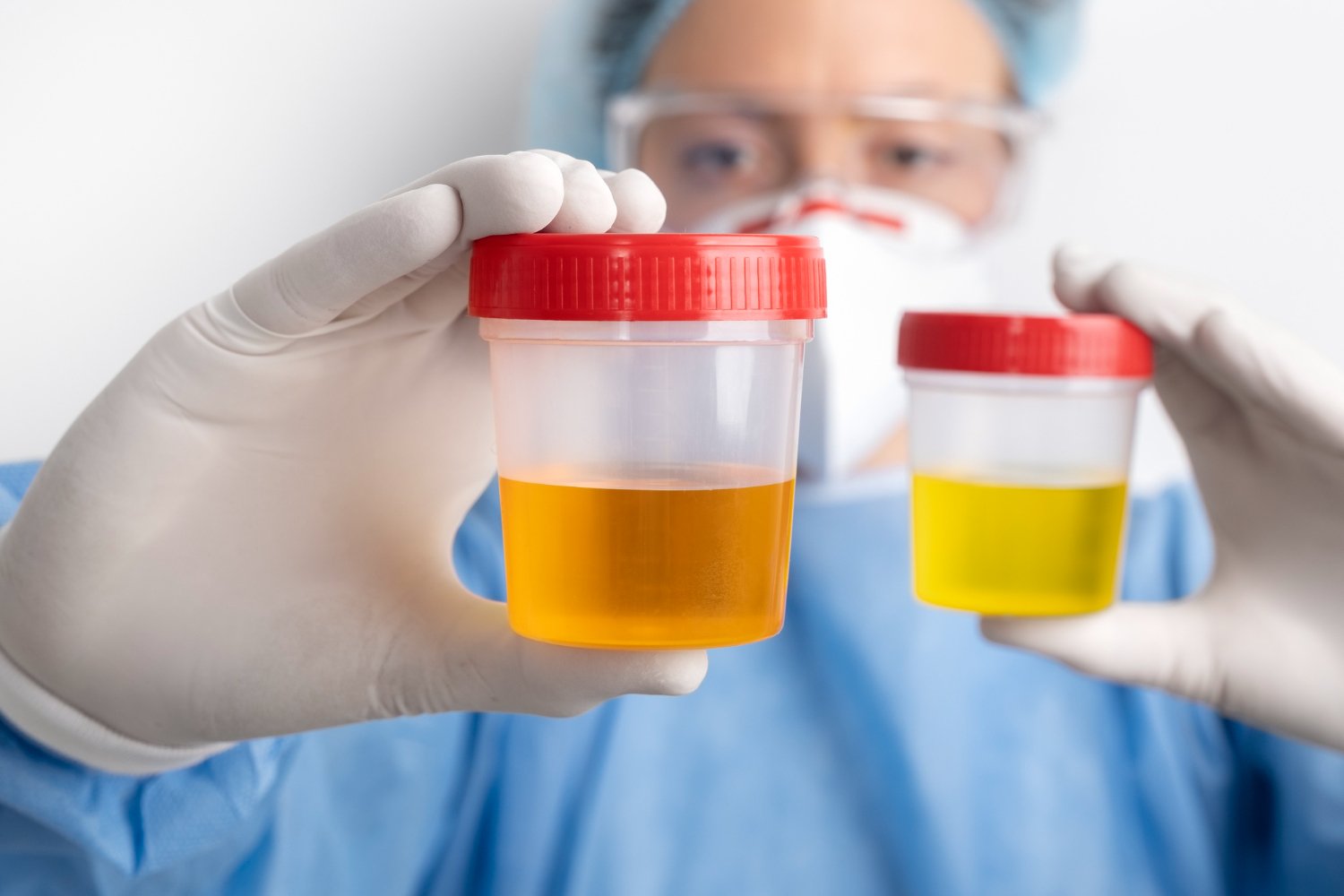 Urine color and health problems